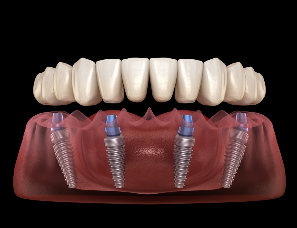 3D model of an All-on-4 full-arch bridge of white teeth supported by four titanium implants in the jaw